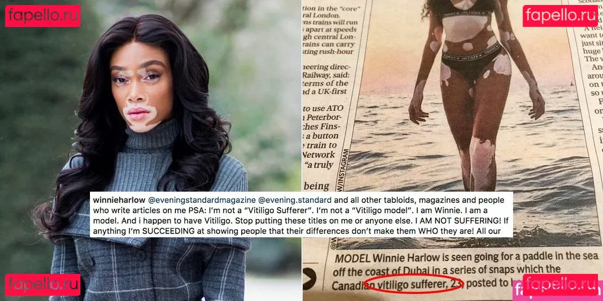 Winnie Harlow Onlyfans Photo Gallery 