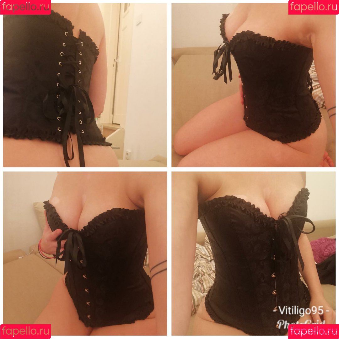 vitiligo95 Onlyfans Photo Gallery 